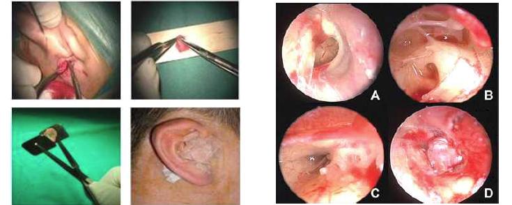 고막성형술(Myringoplasty) 시술 과정.