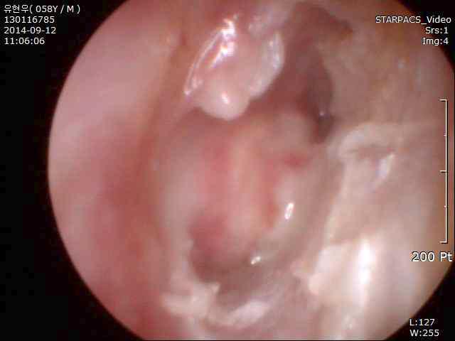 연골막을 이용한 고식적 고막성형술 환자의 수술 2주 뒤 추적관찰 시 고막소견