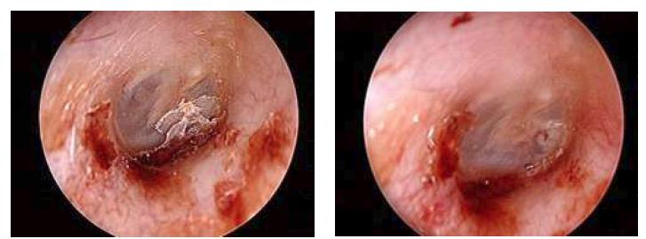 TymPaSil을 이용한 고막성형술 후 2주차 고막사진. 좌측사진: TymPaSil을 통해 고막의 완치상태를 확인할 수 있음. 우측사진: TymPaSil을 제거한 후 고막 상태, 수술전 천공 부위의 일부 두터워진 형태 이외에 전체적으로 고막 상태는 정상화됨