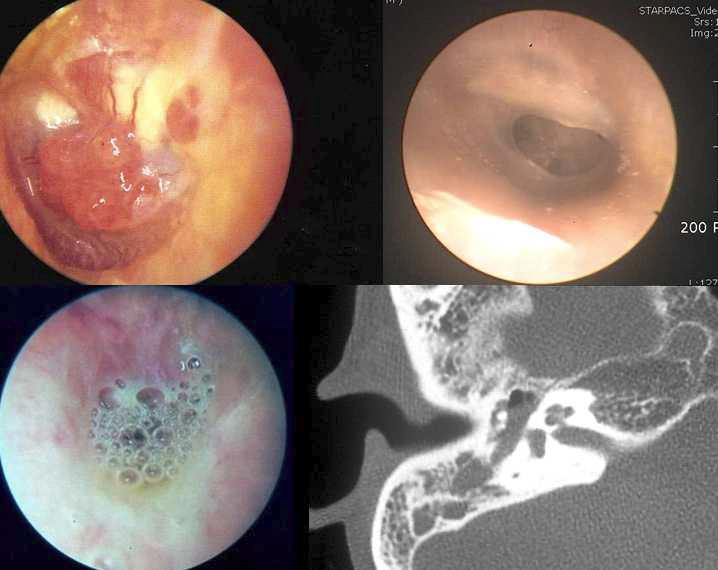 좌측 위: 육아종성 고막염. 좌측 아래: 고막 천공을 통하여 이루가 발생하는 환자 예. 우측 위: 천공과 동반된 이소골 변형. 우측 아래: 유양돌기에 염증소견이 관찰되는 환자 예.