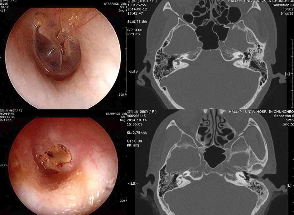 좌측 위: 정상 고막 형태에서 추골병 후방에 작은 천공이 관찰됨. 우측 위: 좌측 위 고막소견환자의 측두골 단층 촬영 소견