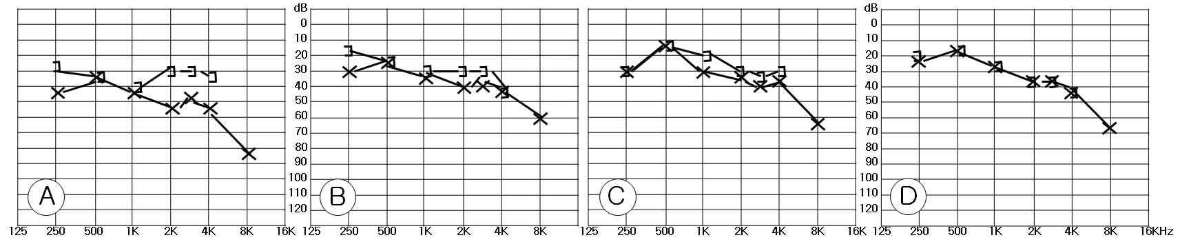 A: 수술 전 순음청력상태. B: 수술 1주후 순음청력상태. C: 수술 2주후 순음청력상태. D:수술 4주후 순음청력상태