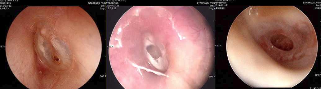좌측: 작은천공 (고막전체면적의 <25%, 47세 여자. 좌측 실크 피브로인 패치술 시행). 중간: 중간 천공 (25%-50%,19세 남자. 좌측 실크 피브로인 패치술 시행). 우측: 큰 천공 (50%-75%, 59세 여자. 좌측 실크 피브로인 패치술 시행)
