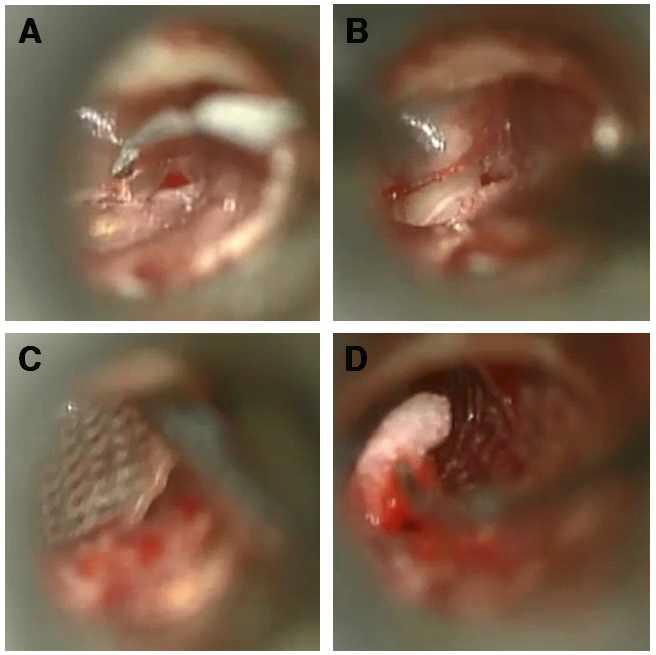 실크 피브로인 패치술의 수술적 방법. A: 작은 천공의 수술전 고막. B: 천공연을 절제함. C: 천공부위에 식염수로 부드럽게 만든 실크 피브로인 패치(TymPaSil)를 천공연 주변에 붙임. D: Gelfoam을 외이도와 패치위에 충전함