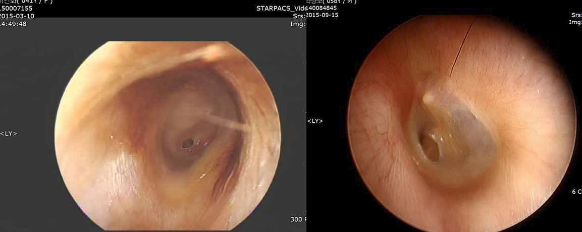 좌측: 수술 후 2주차에 염증발생. (41세 여자. 우측 실크 피브로인 패치술 시행). 염증 발생 시 항생제 2주간 투약하였으나 6개월째 실패로 판정. 우측: 수술 후 6개월째 고막소견 (58세 남자. 우측 실크 피브로인 패치술 시행). 실패판정 후 고식적 고막성형술로 재수술하여 완치판정.