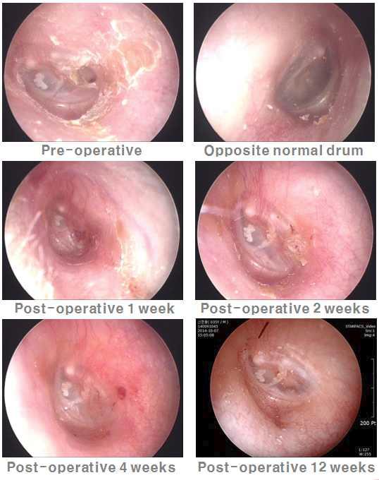 좌측 위: 수술 전 천공 사진. 우측 위: 정상 상태의 반대 측 고막 소견. 좌측 중간: 수술 1주 이후 고막소견. 천공부위에 치유조직으로 차있는 것을 확인함 우측 중간: 수술 2주 후 고막소견. 새로 형성된 고막 위로 각질화 세포가 덥혀있는 것을 확인. 좌측 아래: 수술 4 주후 고막 소견. 치유가 거의 끝나가는 것을 확인. 우측 아래: 수술 후 12주. 치유가 끝남을 확인