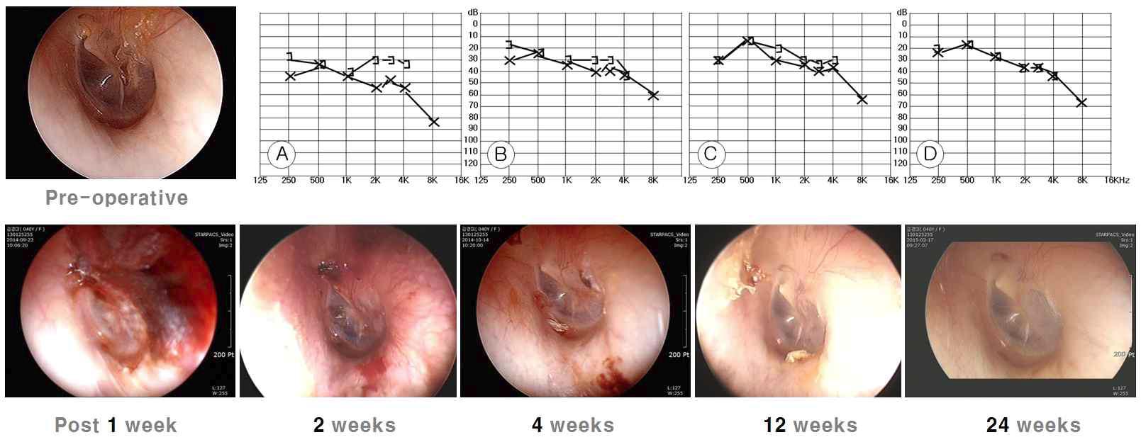 좌측 위: 왼쪽 작은 천공의 수술 전 고막소견. 우측 위: 연속성의 그래프는 수술이 후 순음청력변화를 보여주는 사진. A: 수술 전 기도 골도 청력차이. B: 1주 후 기도 골도 청력차이가 줄어드는 모습. C: 2주 후 기도 골도 청력차이가 줄어드는 모습. D: 4주 후 기도 골도순음 청력사이가 사라진 모습. 아래 사진들: 수술 이후 연속적으로 고막상태가 줄어드는 모습을 보임. 수술 4주 정도에 치유과정은 모두 끝난 상태가 되며, 고막비후, 고실경화증 등의 후유증은 관찰되지 않음