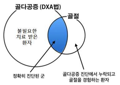 골밀도 검사의 골절 예측 한계점