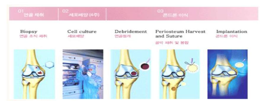 콘드론 시술방법