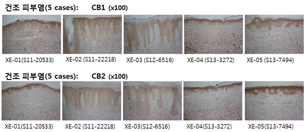 건성 습진 피부의 Cannabinoid receptor 1,2 발현 비교.