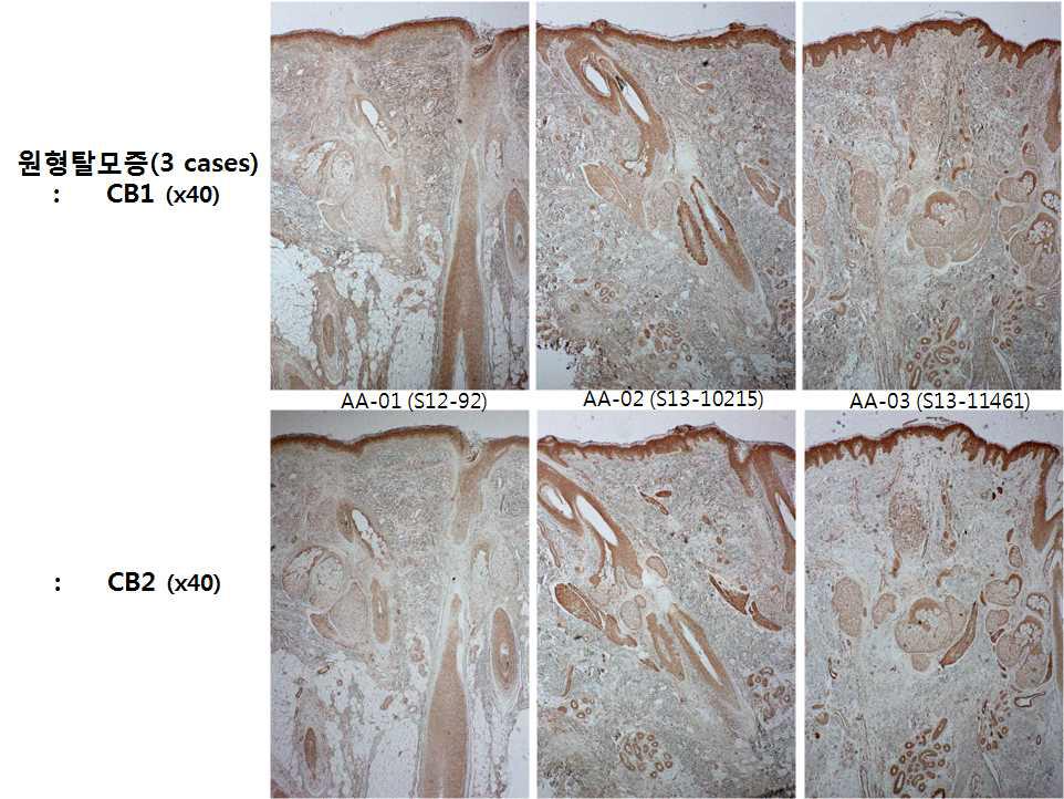 원형탈모증 피부의 Cannabinoid receptor 1,2 발현 비교.