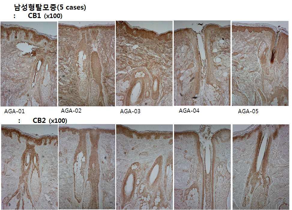 남성형탈모증 피부의 Cannabinoid receptor 1,2 발현 비교.