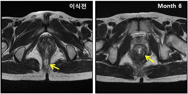 저용량 ALLO-ASC를 투여받은 대상자의 MRI 결과