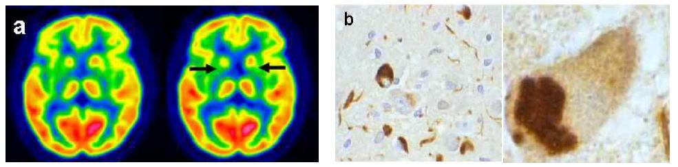 다계통 위축증의 뇌 PET (a) 및 병리학적 소견(b). 말기 다계통 위축증 환자에서 기적핵 (striatum)에 현저한 뇌대사량이 저하되어 있음 (화살표). 기저핵에서 alpha-synuclein 조직 염색에 양성을 보이는 Oligodendrocyte(좌) 및 전자현미경상 oligodendrocyte내에 inclusion body가 관찰됨(우)