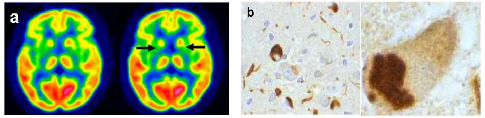 다계통 위축증의 뇌 PET (a) 및 병리학적 소견(b). 말기 다계통 위축증 환자에서 기적핵(striatum)에 현저한 뇌대사량이 저하되어 있음 (화살표). 기저핵에서 alpha-synuclein 조직 염색에 양성을 보이는 Oligodendrocyte(좌) 및 전자현미경상 oligodendrocyte내에 inclusion body가 관찰됨(우)