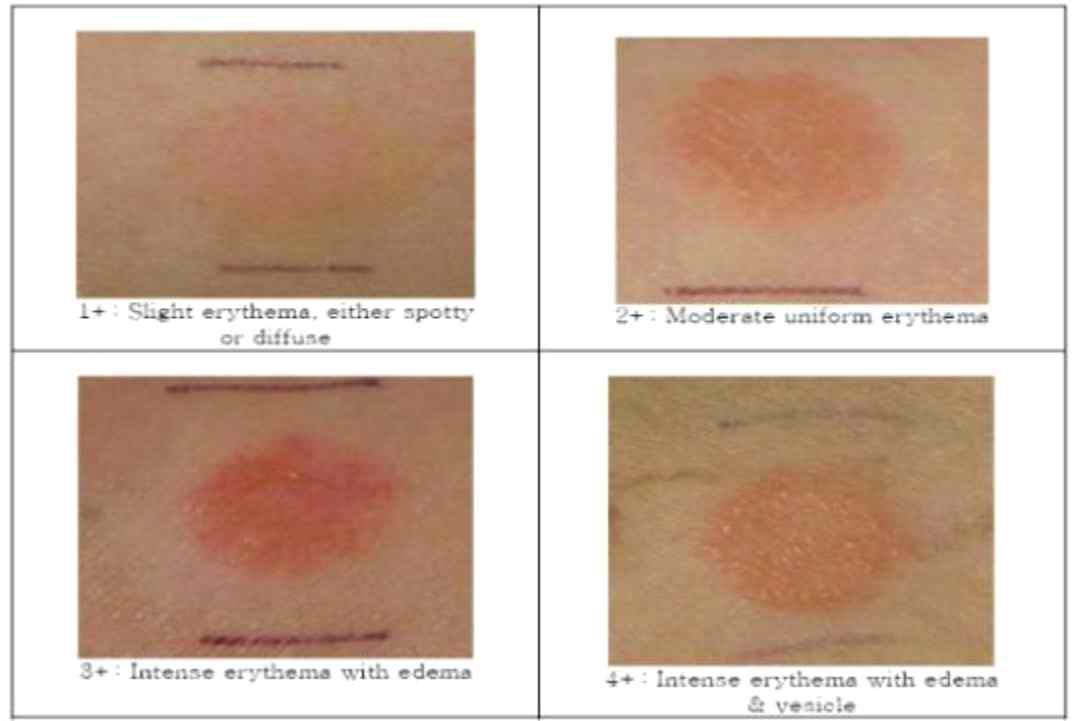 Clinical standard photographs of visual assessment for human patch test