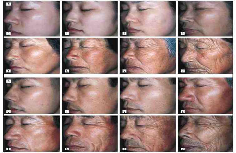 Photographic scale used to grade the overall severity of facial wrinkles