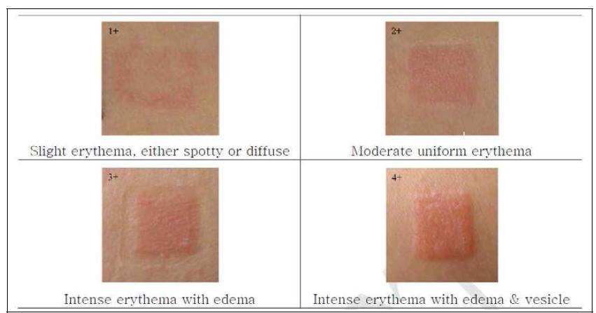 피부반응도 평가 기준