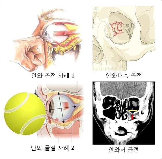 안와골절의 발생기전