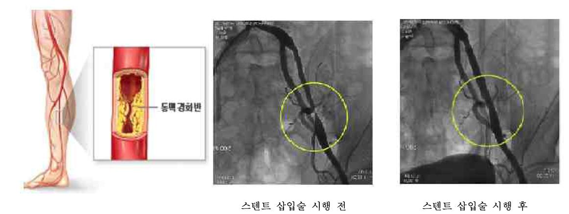 스텐트 삽입술을 이용한 말초혈관 치료