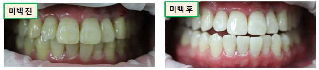 치아미백 생활치 유효성 평가 결과 예시