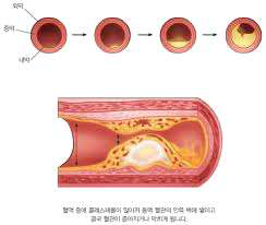 허혈성 혈관질환 모형