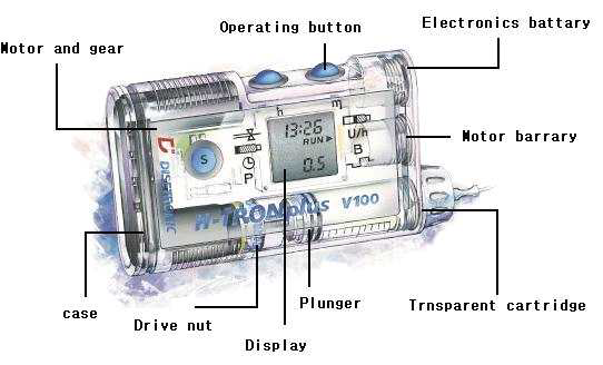 An example of the Insulin pump