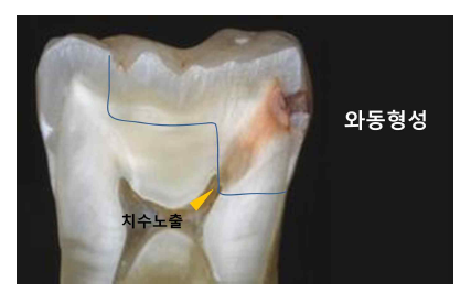 와동 형성과정