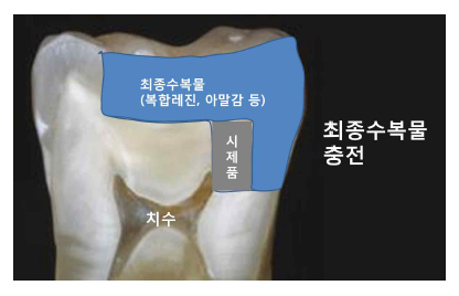 최종수복물의 적용.