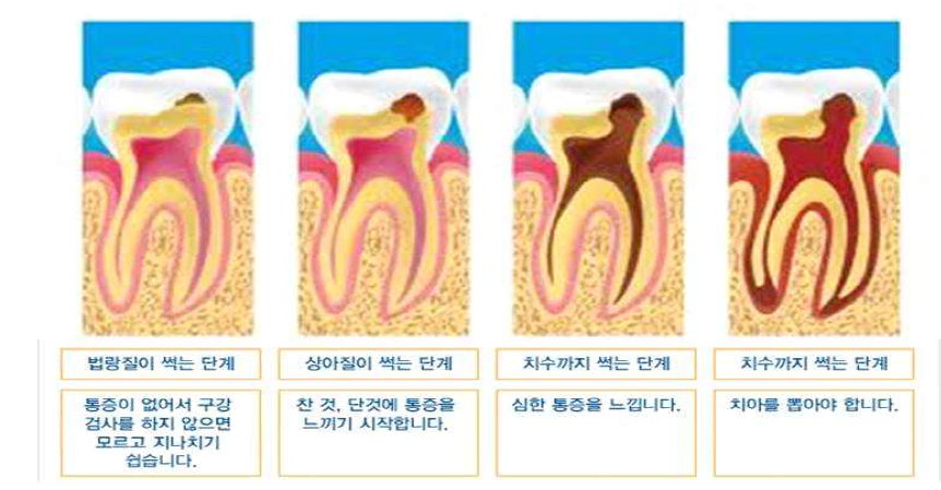 치아우식증의 진행과정