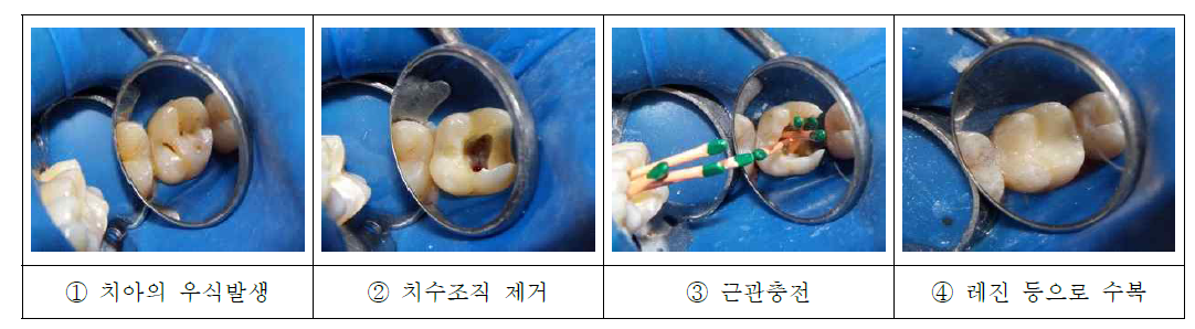 기존 근관 치료 과정으로 치아 내 치수 조직을 완전히 제거한 이후 근관충전재료로 충전 및 밀폐를 하게 된다.