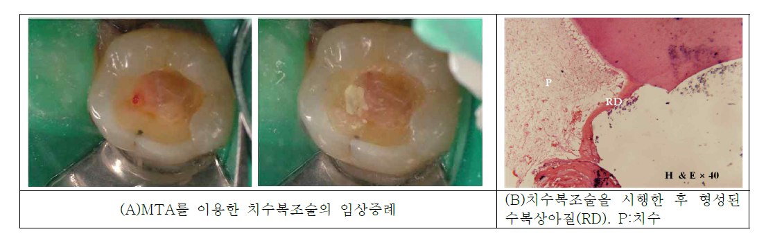 MTA를 이용한 치수복조술.