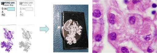 좌측: 파라핀 조직을 추가로 세절(두께 5 ㎛)하여 주사전자현미경용 관찰 대에 올림. 우측: 악성중피종 세포들 사이 틈에 관찰되는 미세융모를 관찰함.