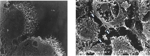 좌측: 분화가 좋은 악성중피종의 종양세포 표면에 많은 수의 기다란 미세융모를 관찰함. 우측: 분화가 나쁜 악성중피종의 종양세포 표면에 관찰된 미세융모(화살표).