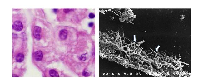 파라핀 잔여조직을 사용하여 광학현미경에서 종양세포들 틈에 희미하게 보이는 미세융모(좌측)를 주사전자현미경 관찰을 하면 악성중피종 종양세포 표면에 많은 미세융모 존재(화살표)를 관찰함(우측)