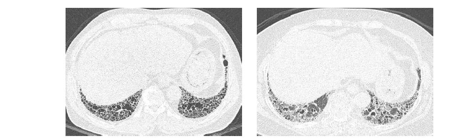 69세 석면폐증 환자(A)와 77세 특발성폐섬유화 환자(B)의 흉부 CT 소견.
