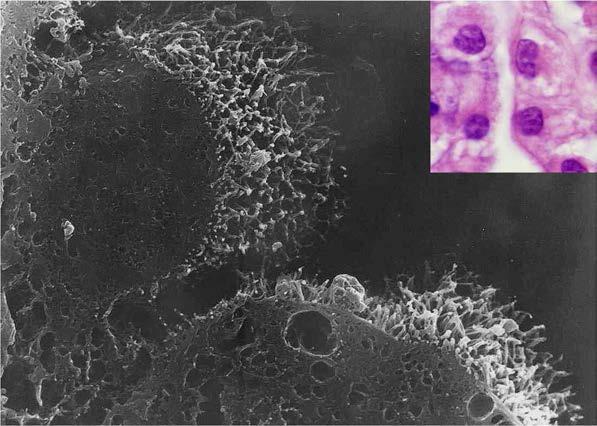 악성중피종 종양세포 표면의 미세융모 구조 악성중피종의 종양세포 표면에 관찰되는 많은 수의 미세 융모 구조를 볼 수 있다