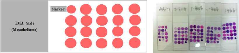 악성중피종 Tissue Microarray