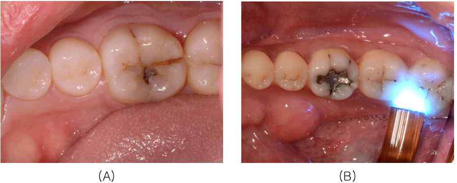 전형적인 하악 제일대구치의 균열(A), 균열치의 transillumination 진단법(B)