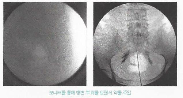 영상 중폭장치를 이용하여 병변 부위 확인 및 약물 주입 과정