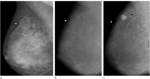 유방암(Mammography) 영상 진단 예