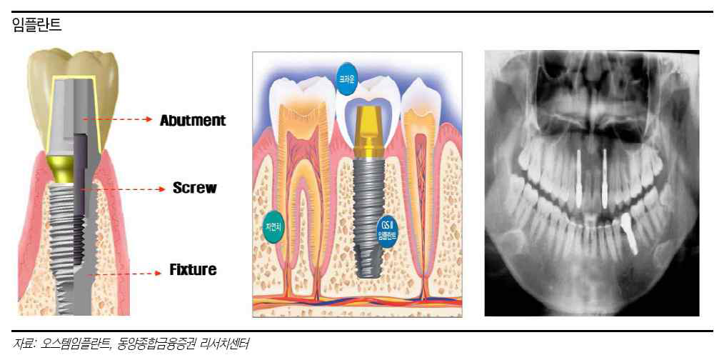 치과용 임플란트의 구조와 적용 사례.
