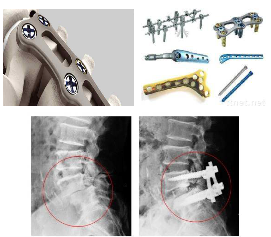 척추고정술용 임플란트의 구조와 적용 사례.