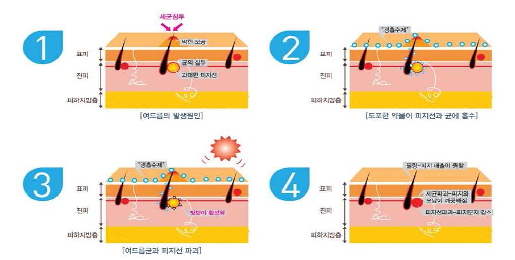 ALA 기반 광민감제 PDT 여드름 치료