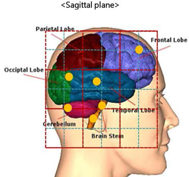 Sagittal plane에서 종양 위치 선정