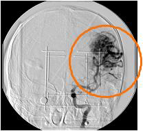 DSA x-ray image (Frontal image)