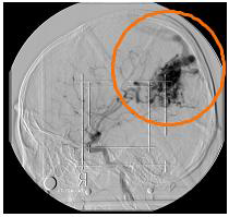 DSA x-ray image (Lateral image)