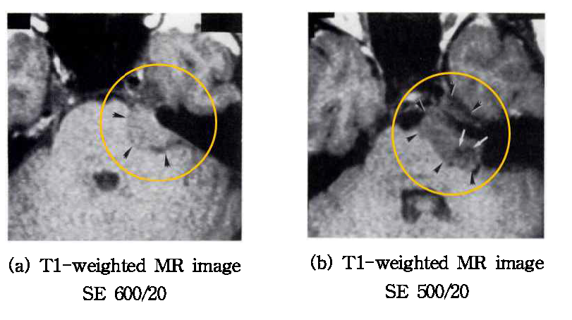 Meningioma