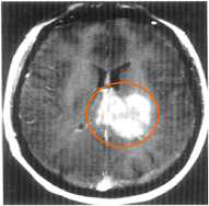 T1 MT-FLASH GRE (case1)