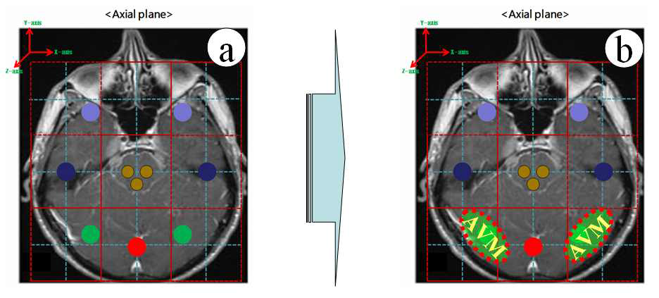 Axial plane 에서의 AVM 및 brain tumor 위치.